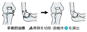 変形性肘関節症