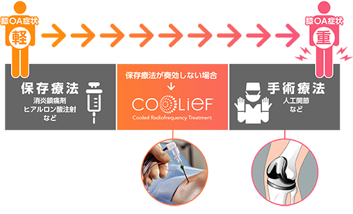 クーリーフ治療（膝ラジオ波焼灼療法）