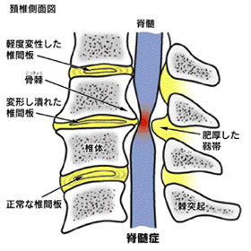 頸椎症