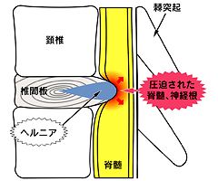 頸椎椎間板ヘルニア