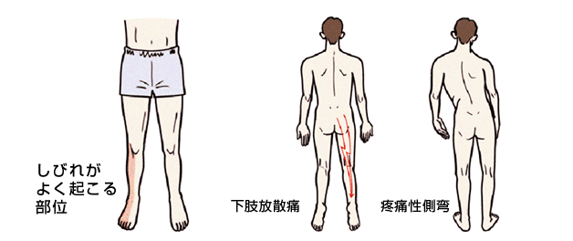 腰椎椎間板ヘルニア