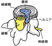 腰椎椎間板ヘルニア